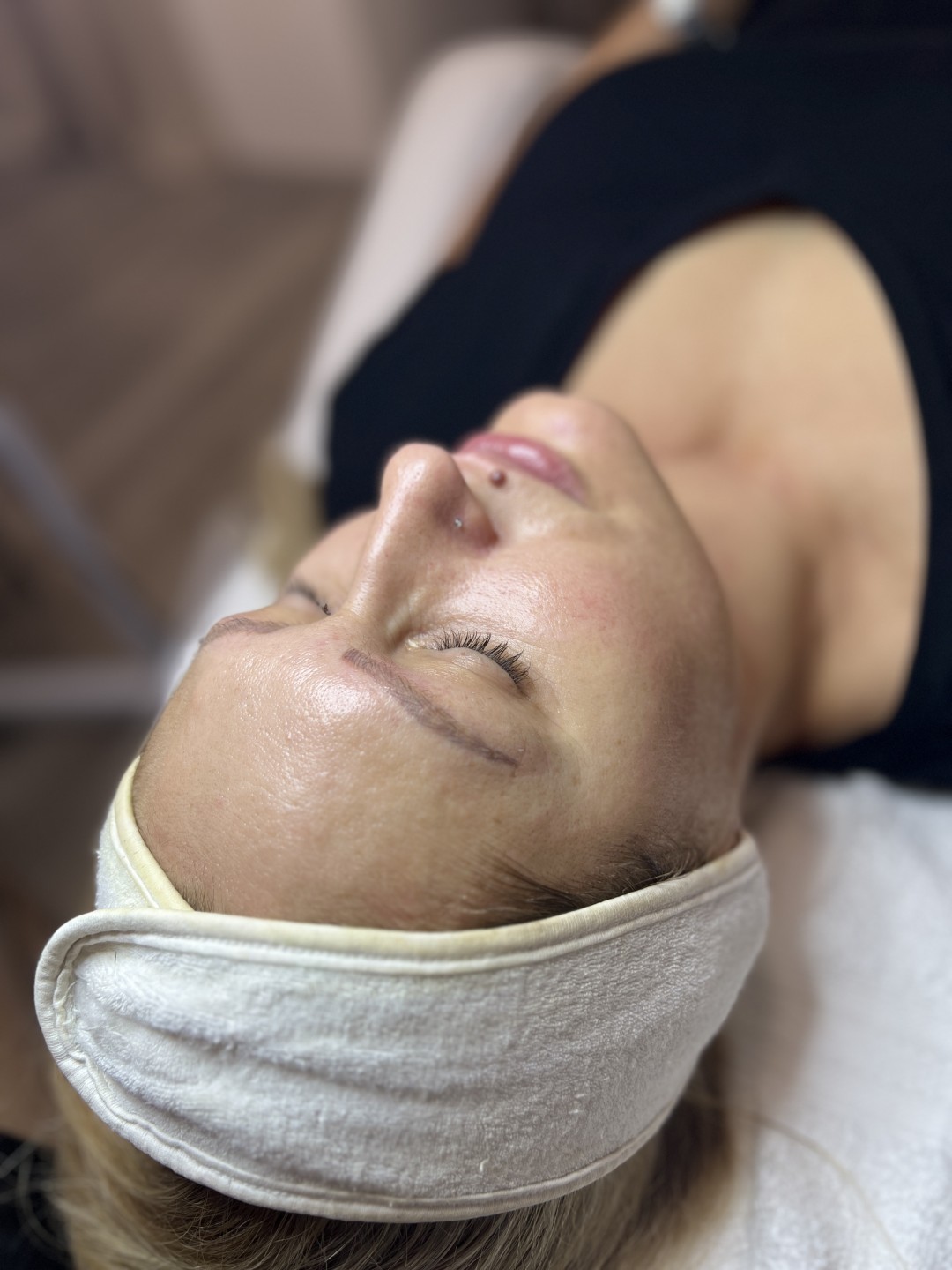 Step up beauty #beograd Tretman lica Biorevitalizacija lica - hemijski piling+ mezokoktel