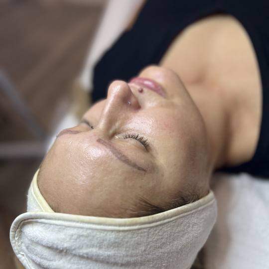 Step up beauty #beograd Tretman lica Biorevitalizacija lica - hemijski piling+ mezokoktel