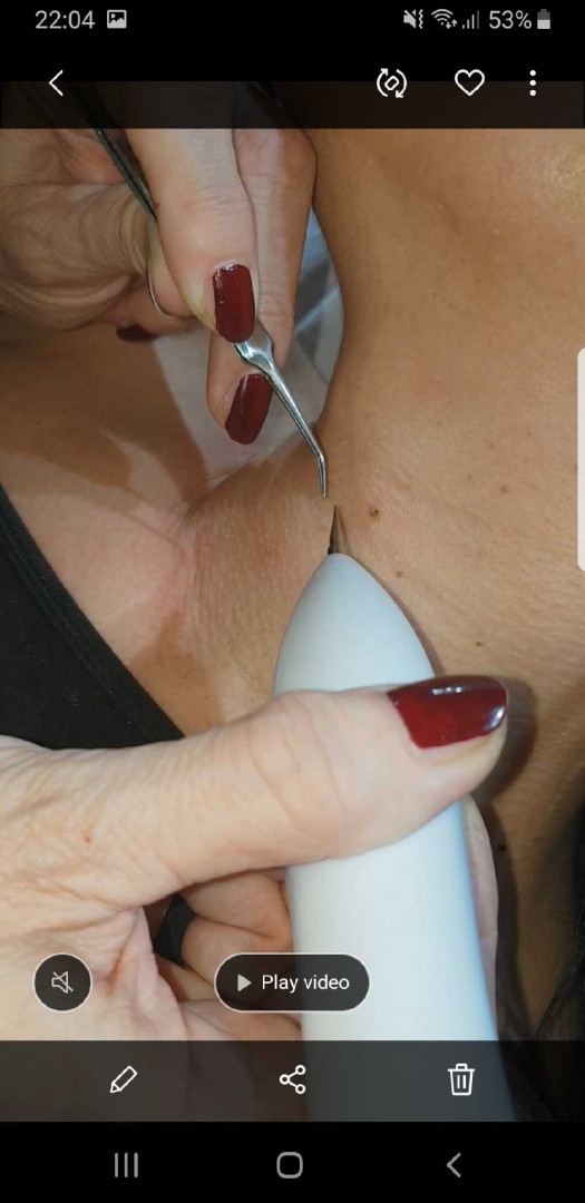 Grossi cosmetic #beograd Tretman lica