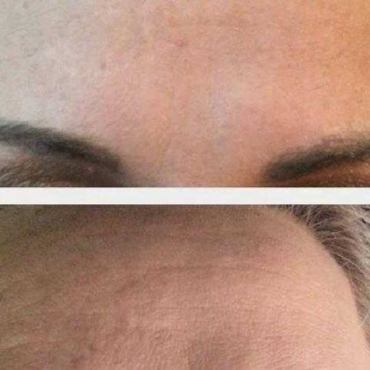 First lady #beograd Mezoterapija lica Mezoterapija lica dermapenom - uklanjanje bora sa čela