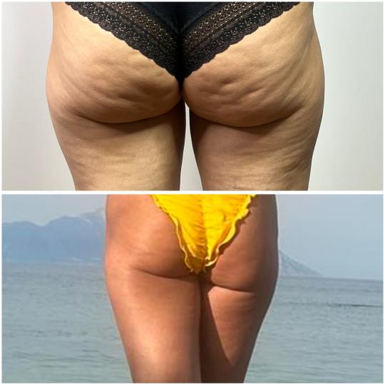 Belle Ana #beograd Tretmani tela EMS tretman - 2 regije