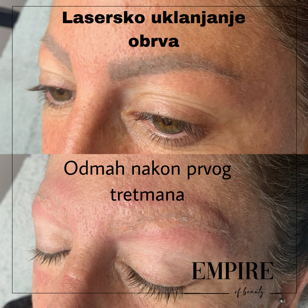 Guardian Beauty Centar & Milica Tepavac #beograd Trajna šminka Lasersko uklanjanje trajne šminke