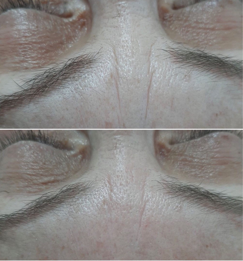 Look at me #beograd Tretmani protiv bora 3D Wrinkle tretman lica