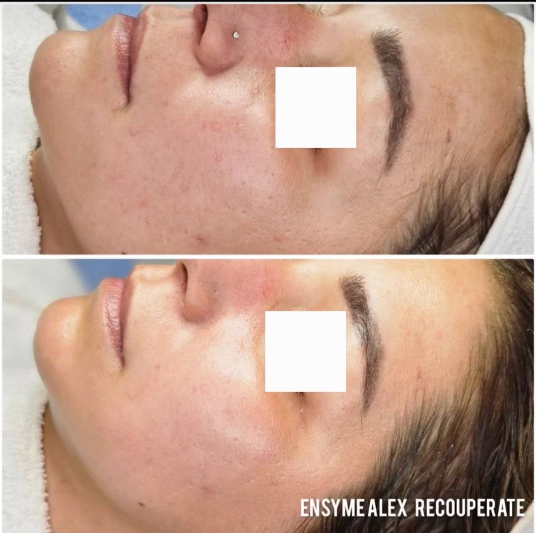 Beauty salon XL Lady #beograd Tretman lica Enzimski piling - Recouperate