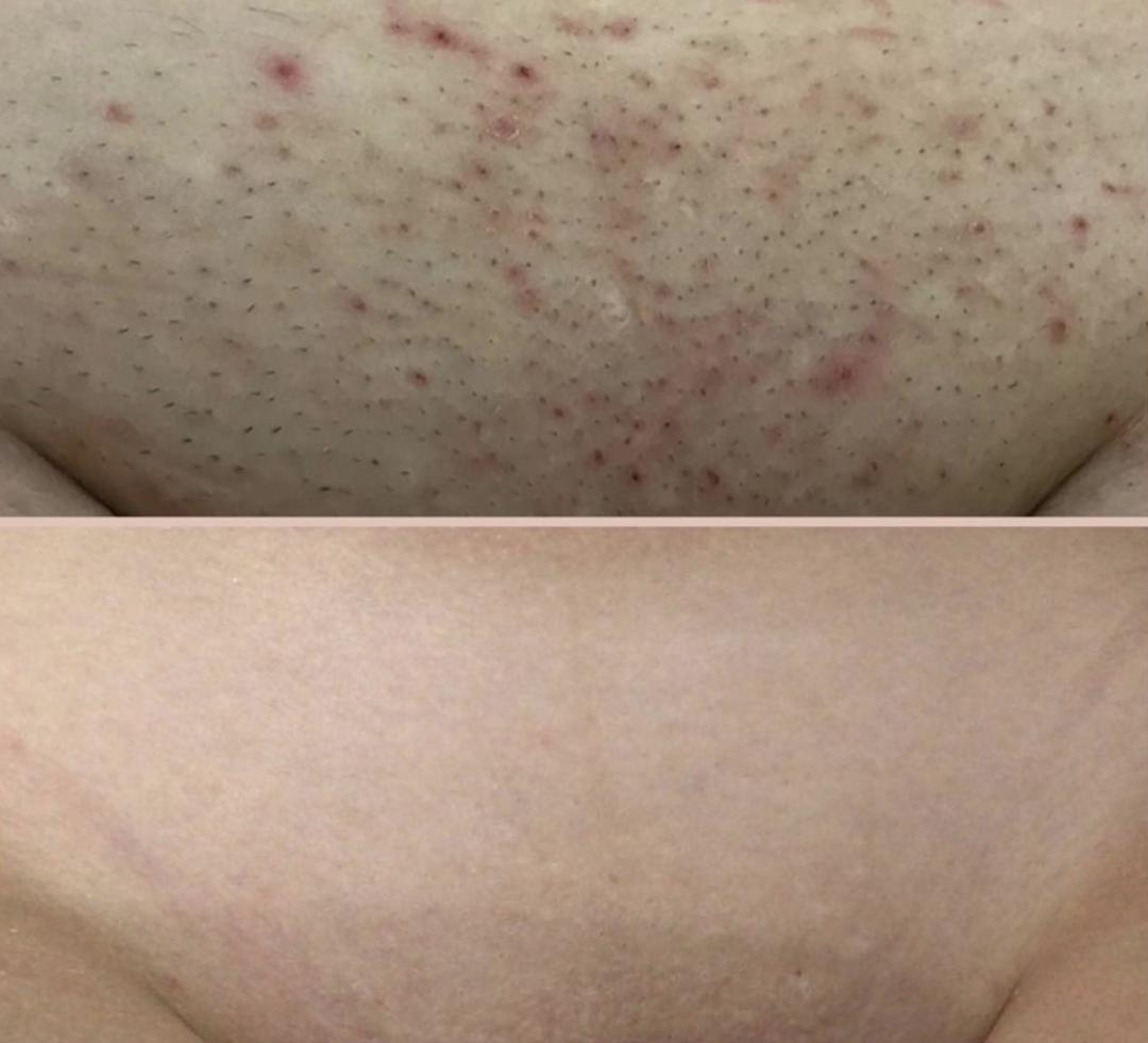 Maison de mi #beograd Laserska epilacija Laserska epilacija intimne regije za dame - paket od 7 tretmana