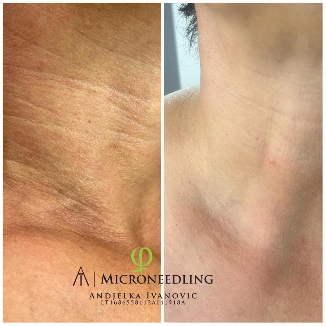 Microneedling tretman - vrat + dekolte - Belle Ana, Beograd Tretmani vrata i dekoltea Lice Tretmani vrata i dekoltea, Beograd, Vračar, Čubura, Crveni krst