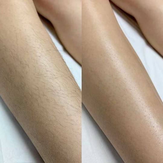 AmiSo Beauty Studio #novisad Depilacija voskom Depilacija pola nogu hladnim voskom/ šećernom pasto