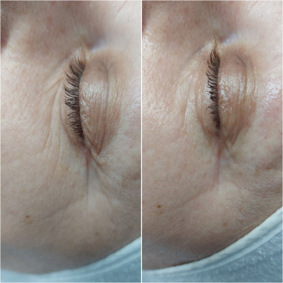 Look at me #beograd Tretman lica Eyelid booster