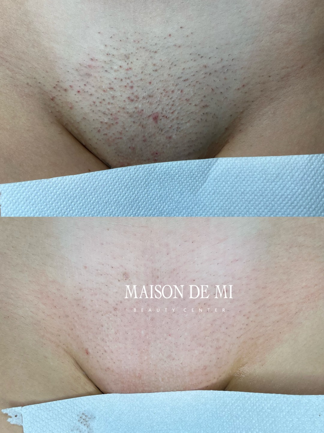 Brazilska laserska epilacija - paket od 4 tretmana - Maison de mi, Beograd Laserska epilacija Depilacija Laserska epilacija, Beograd, Vračar, Čubura, Crveni krst