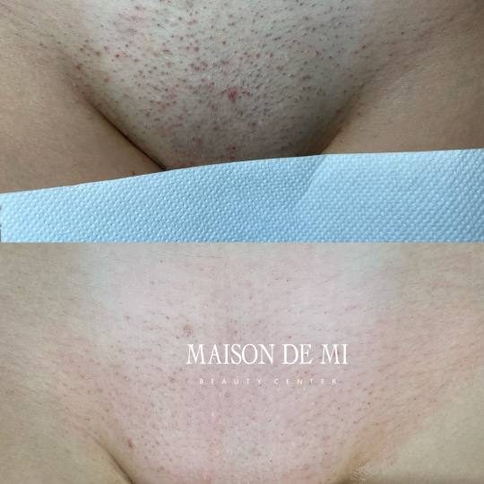 Maison de mi #beograd Laserska epilacija Brazilska laserska epilacija - paket od 4 tretmana Nakon 6 