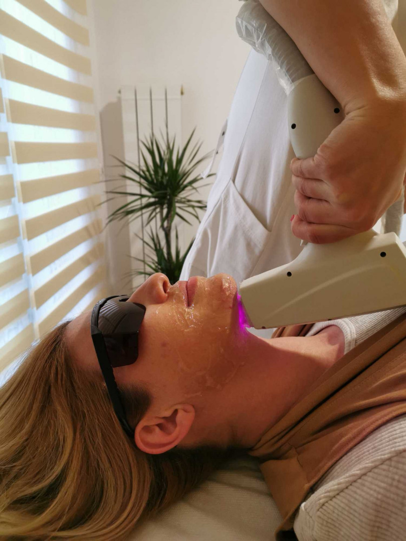 D&D Beauty Center #beograd Laserska epilacija Laserska epilacija celog lica - za dame