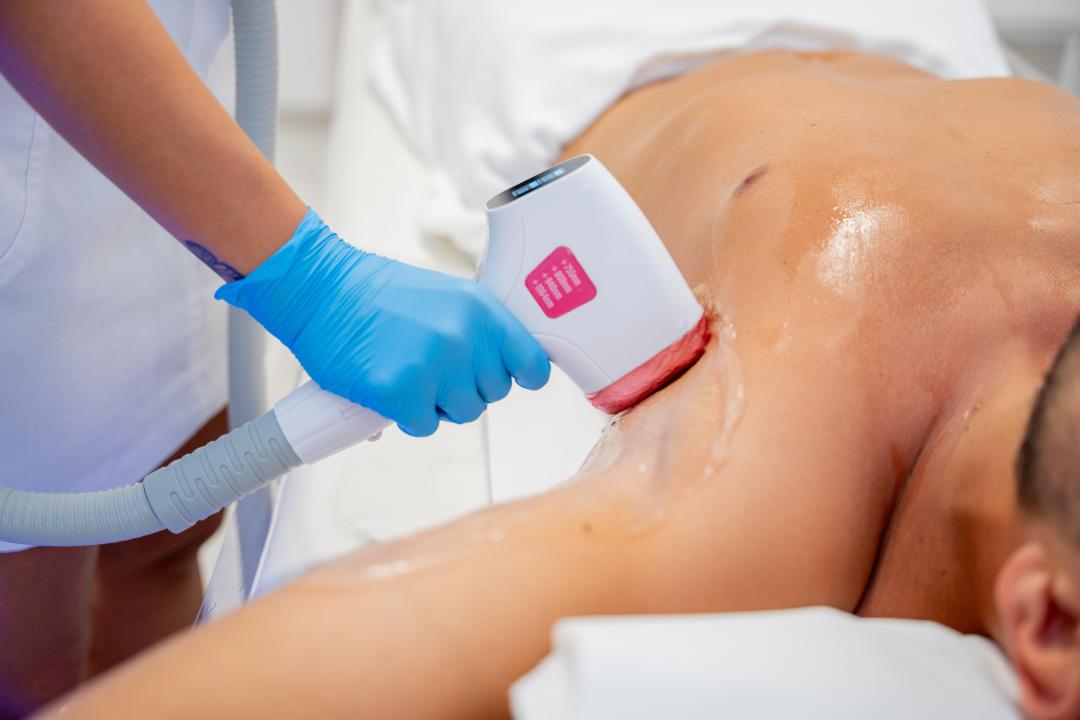 Laserska epilacija gornjeg dela tela bez lica - za muškarce - Monika Barta Cosmetics - Subotica, Subotica Laserska epilacija Depilacija Laserska epilacija, Subotica, Centar