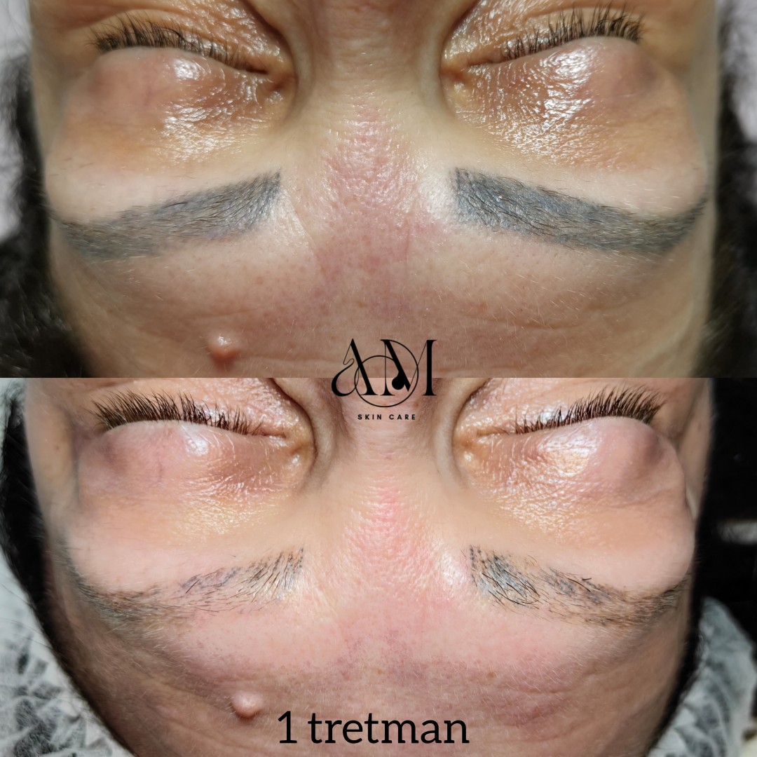 AM BEAUTY STUDIO #odzaci Trajna šminka Uklanjanje trajne šminke obrva