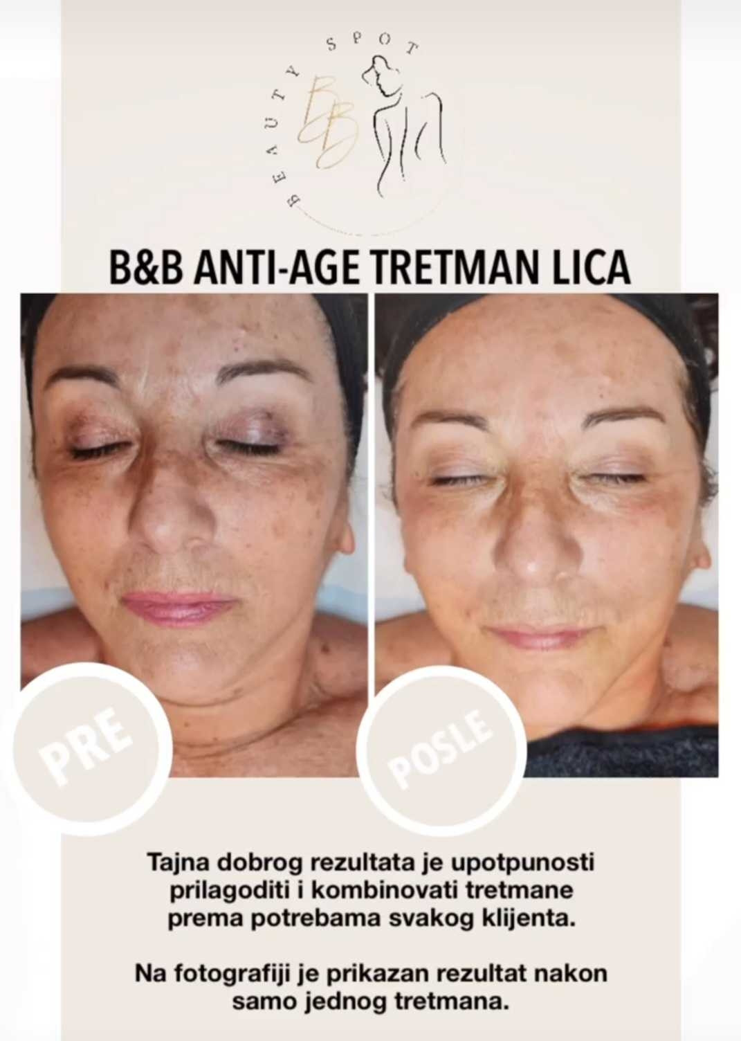 B&B Beauty Spot #novisad Tretman lica