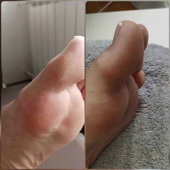 Skin Expert Aesthetic & Laser centar #beograd Medicinski pedikir Medicinski pedikir + lakiranje nokt