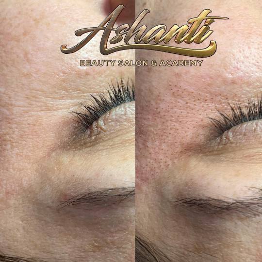 Ashanti Beauty Salon & Academy #beograd Tretman lica Plasma pen - podočnjaci