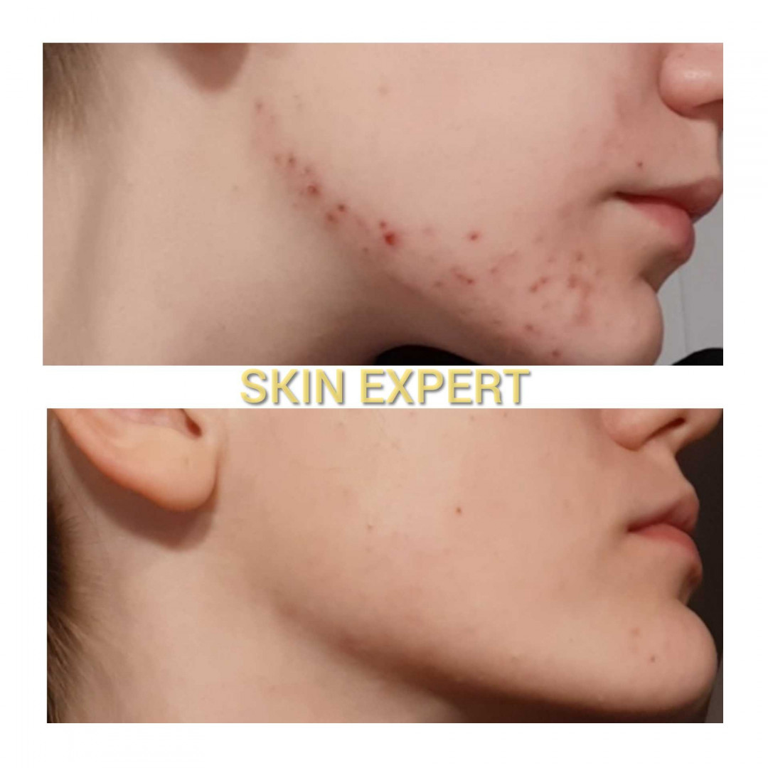 Skin Expert Aesthetic & Laser centar #beograd Piling lica Hemijski piling