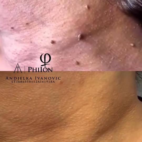 Belle Ana #beograd Tretman lica Phi-Ion tretman - bradavice / papilomi / keratoze / milije / hiperpi
