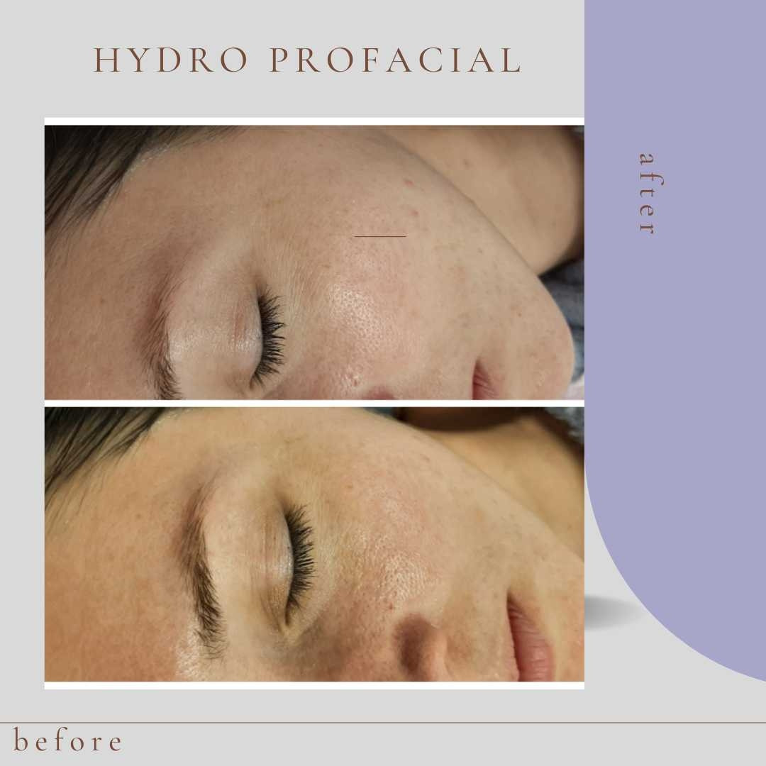 Felicita #beograd Tretman lica Hydro Pro Facial 7in1