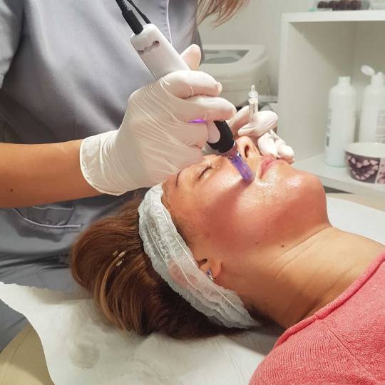 Unna Centar #beograd Tretman lica #mezoterapija #dermapen #nega lica Tretman lica dermapenom - lice 