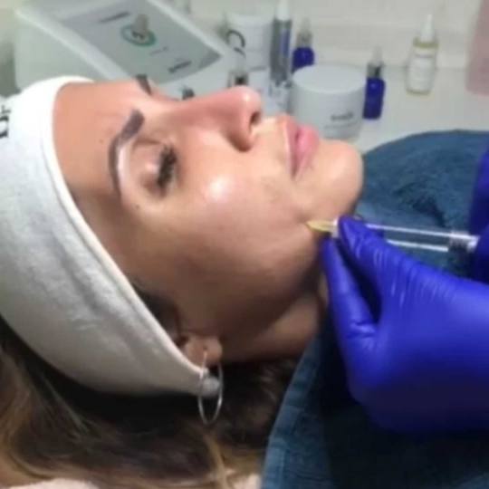 Ordinacija Epil Medic #beograd Biorevitalizacija lica - Hyalift Pro