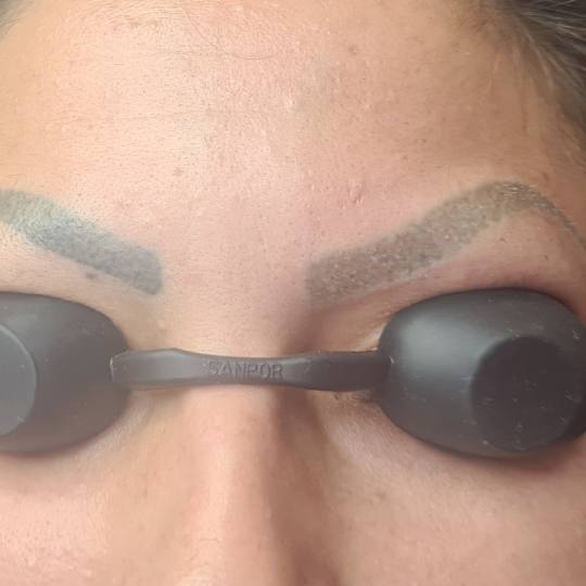 Laser centar Delight #beograd Trajna šminka Uklanjanje trajne šminke laserom obrva ili usana Razlo