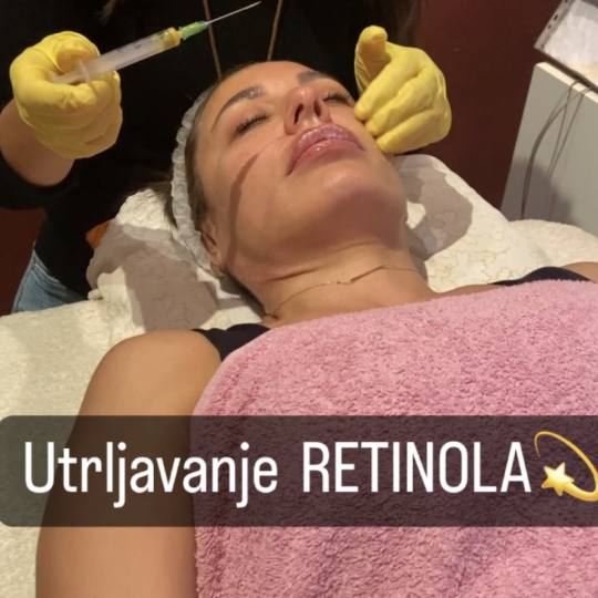La Femme #beograd Dermaroler i dermapen Tretman lica Retinolom Hemiski piling. Odlican za hiperpigme
