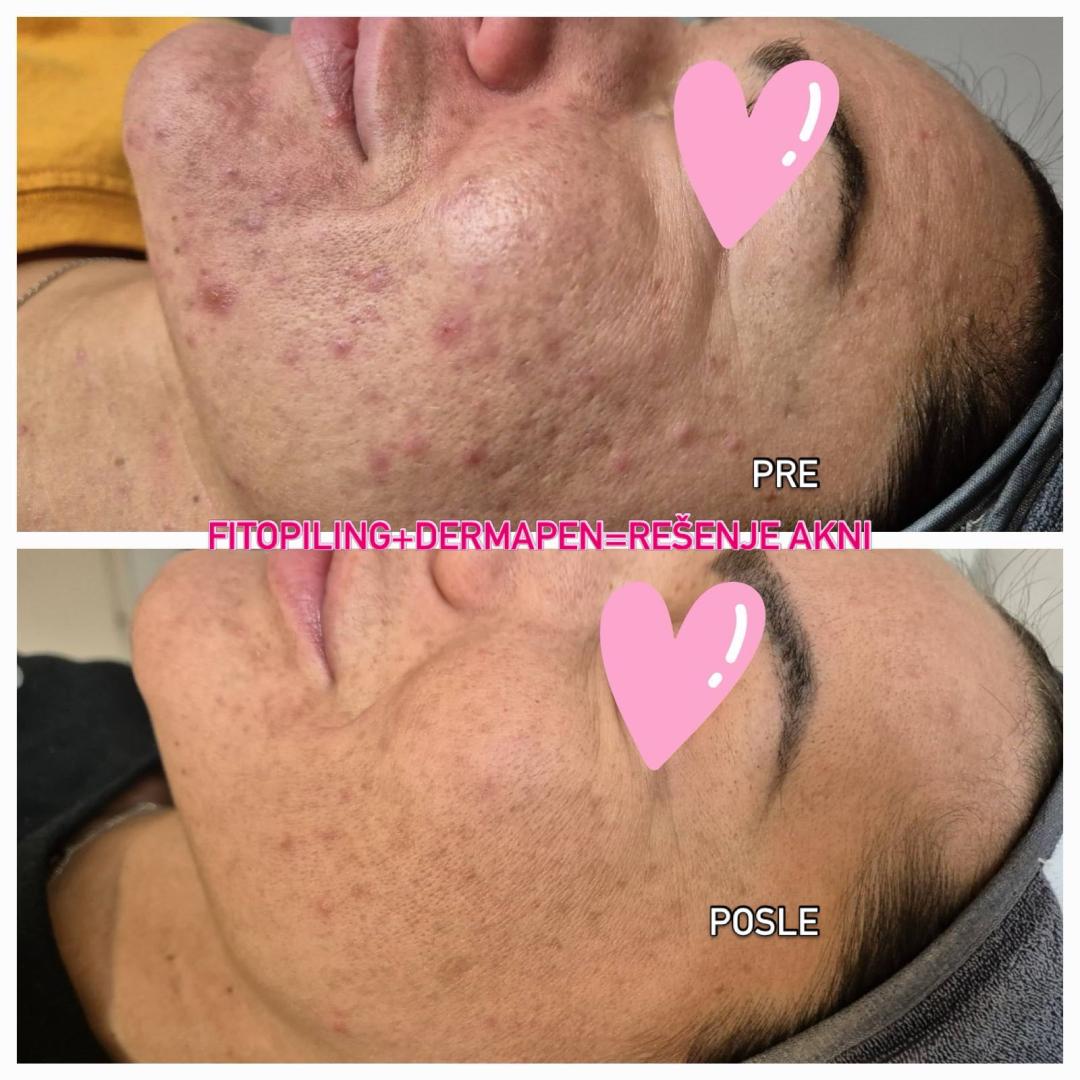 Higijenski tretman lica + Dermapen – Acne QS Hacker Therapy - Happy Lady, Beograd Tretman lica Lice Tretman lica, Beograd, Centar, Stari grad, Dorćol