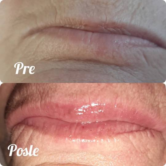 Studio Venera J #beograd Tretman lica Derm fix - Hydra lips tretman - tretman za negu ispucalih i su