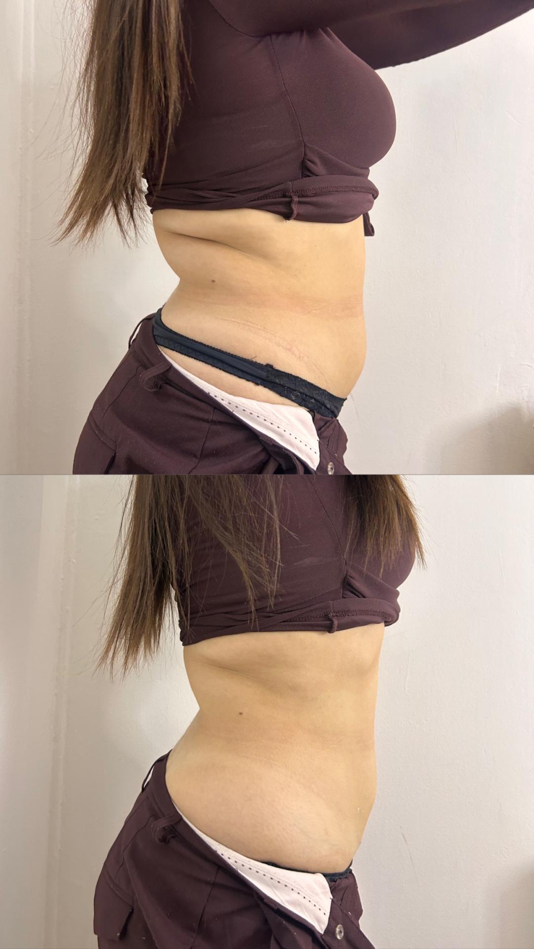 Kavitacija - Lara Beauty 037, Kruševac Kavitacija Telo Kavitacija, Kruševac, Centar