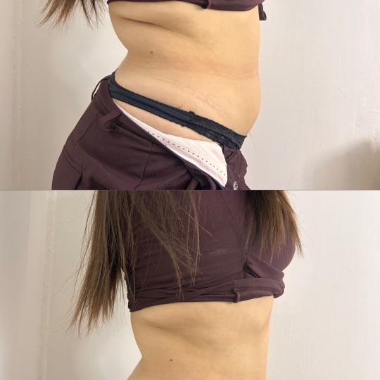 Lara Beauty 037 #krusevac Kavitacija Kavitacija