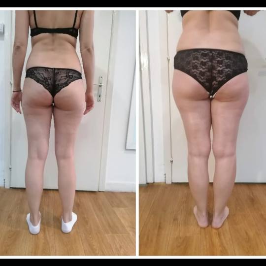 Brankica beauty artist #beograd Anticelulit masaža Maderoterapija