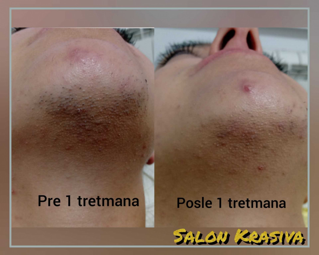 Krasiva #beograd Laserska epilacija Laserska epilacija celog lica - za dame