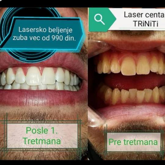 Laser centar Triniti Beograd #beograd Zubi Lasersko izbeljivanje zuba - 3 tretmana