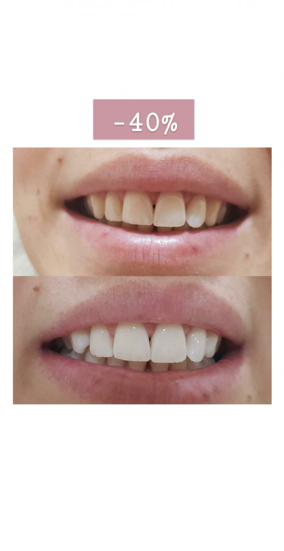 SkinLab Beauty Centar #novisad Korekcija noktiju Izbeljivanje zuba
