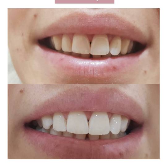 SkinLab Beauty Centar #novisad Korekcija noktiju Izbeljivanje zuba