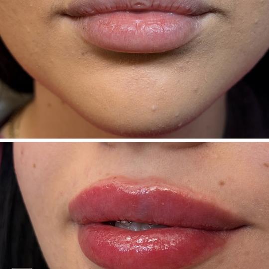 DajanaAesthetics #novisad Dermalni fileri Korekcija usana -1ml Radiant filera