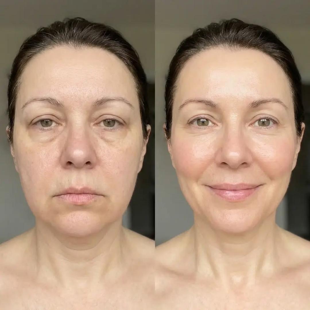 Hifu tretman - lice - Beauty Glam House, Niš Tretmani protiv bora Lice Tretmani protiv bora, Niš, Medijana