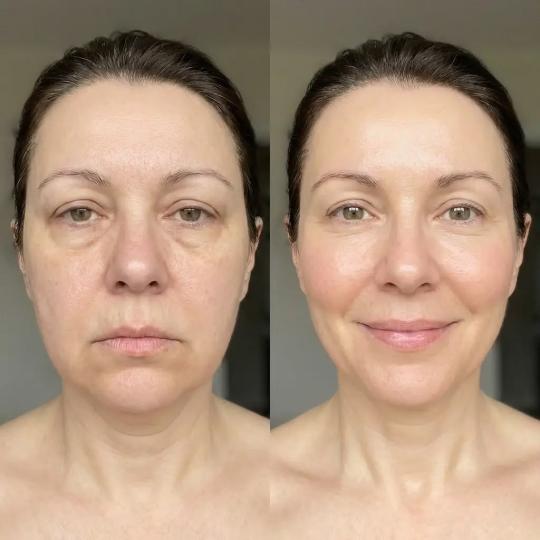 Beauty Glam House #nis Tretmani protiv bora Hifu tretman - lice