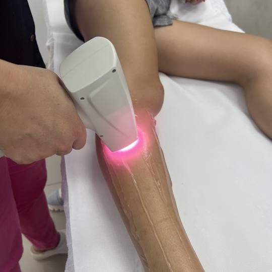 GM Beauty studio #beograd Laserska epilacija Laserska epilacija celih nogu - za dame Laserskom epila