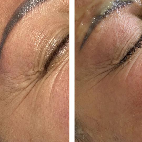 Beauty and nutrition #beograd Tretman lica Botox prah+dermapen+voćne kiseline+serumi za anti age+ma