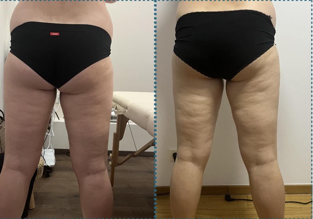 Kavitacija + limfna drenaža + ručna anticelulit masaža + radiotalasi - Diamond beauty, Beograd Kavitacija Telo Kavitacija, Beograd, Zemun Centar