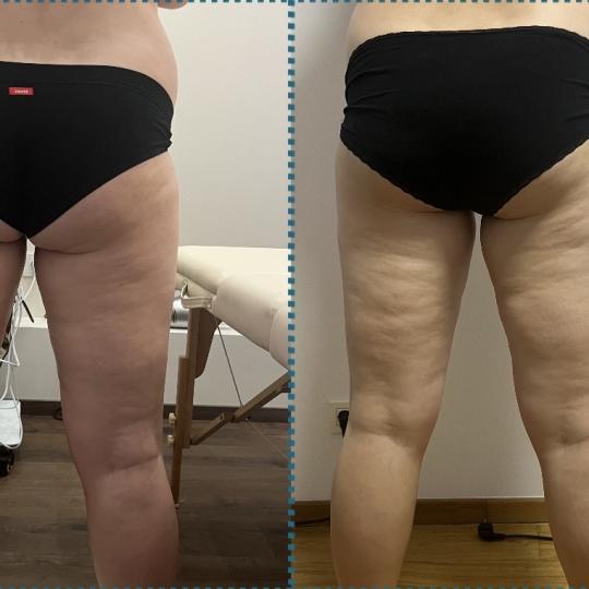 Diamond beauty #beograd Kavitacija Kavitacija + limfna drenaža + ručna anticelulit masaža + radio