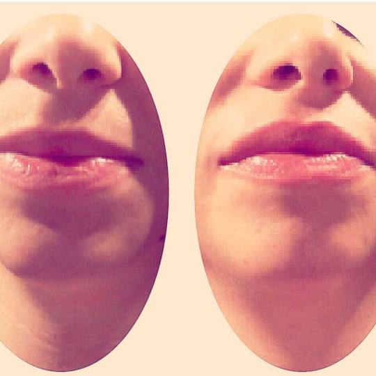 Grossi cosmetic #beograd Tretman lica