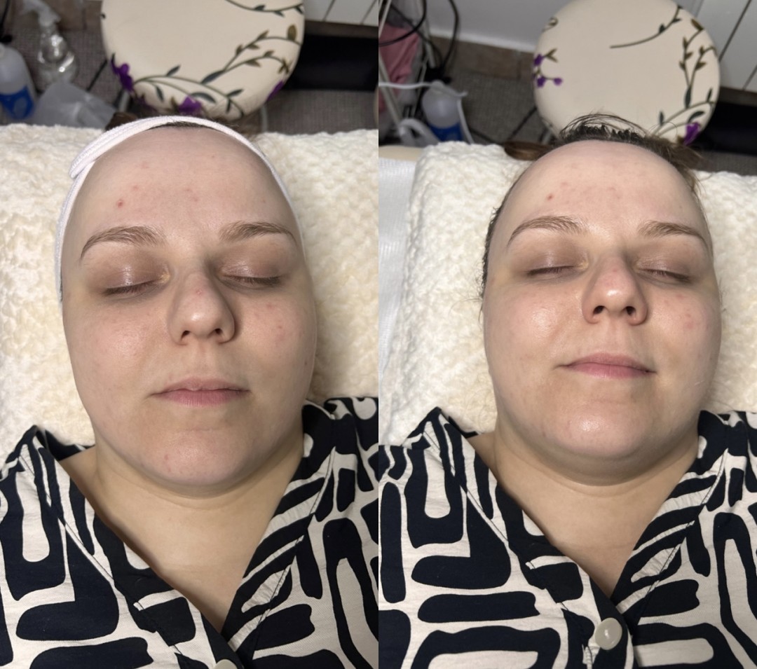 Glam&Glow #beograd Tretman lica Tretman za hidrataciju kože lica