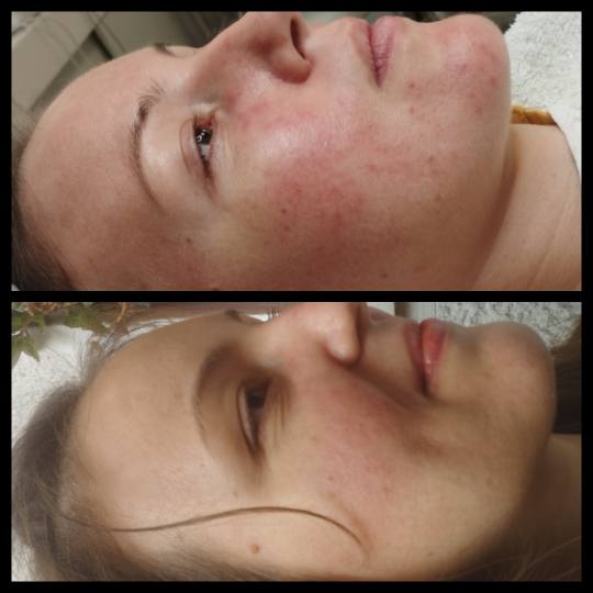 Iva Beauty Lab 2 #beograd Mezoterapija lica Doucer marine- tretman za osetljivu kožu i sklonu crven