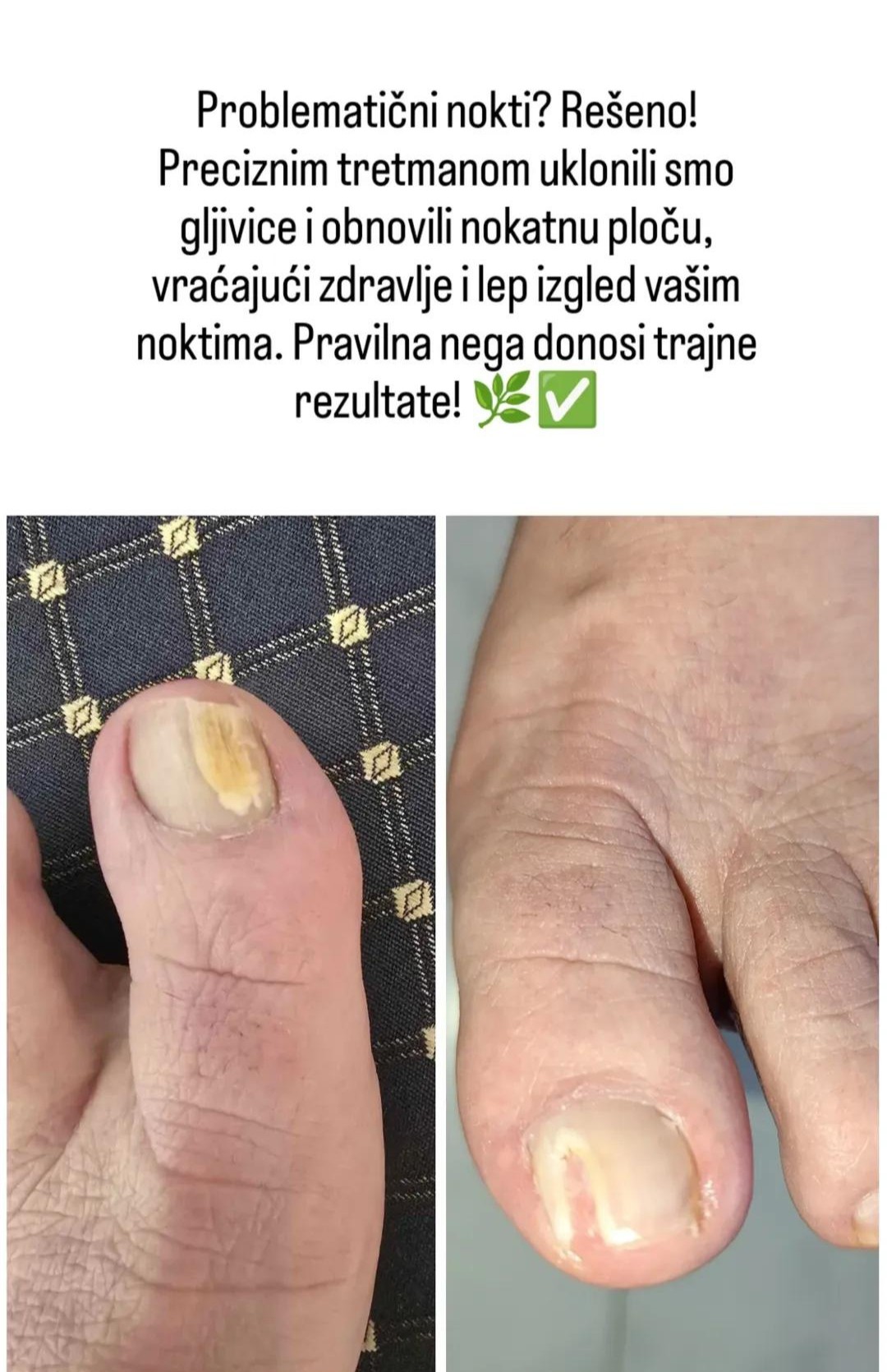 Hellena Cosmetics #novisad Medicinski pedikir Medicinski pedikir - Zdrav korak