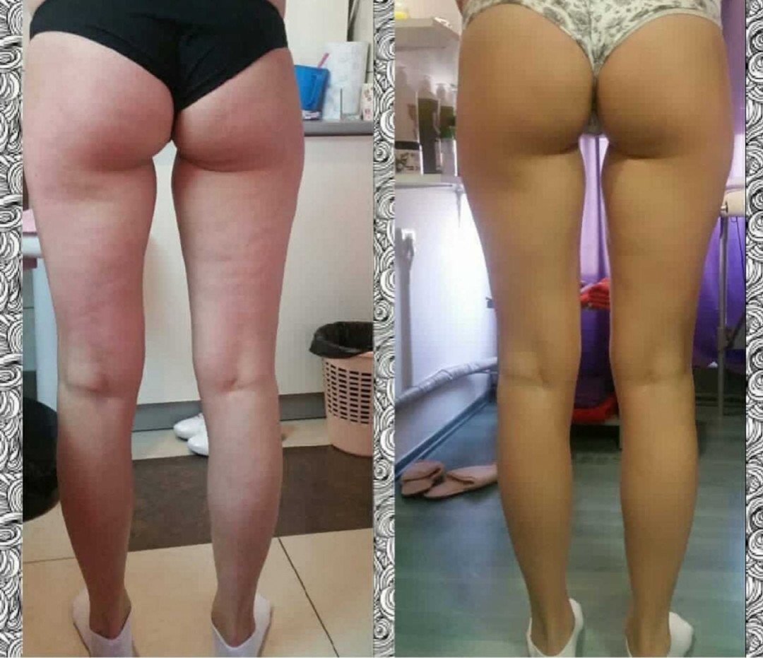 Milica Vlado Profesional #novisad Anticelulit masaža