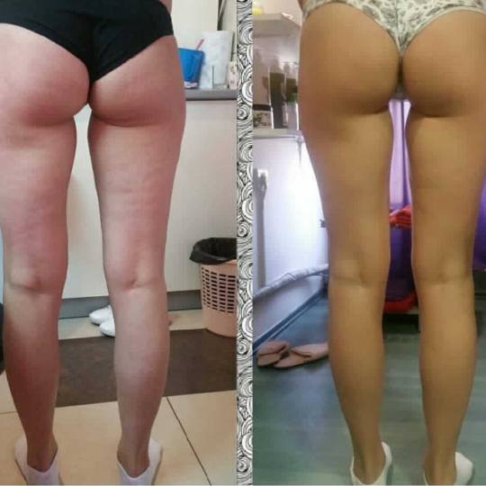 Milica Vlado Profesional #novisad Anticelulit masaža