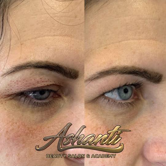 Ashanti Beauty Salon & Academy #beograd Tretman lica Plasma pen - gornji kapci